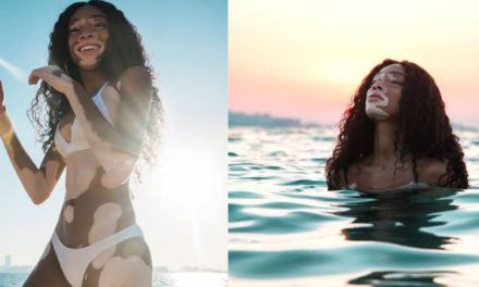 Ella es Winnie, la hermosa modelo con vitiligo que es una celebridad