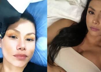 Renata González se inyectó la cara para mostrar cómo se quitan las arrugas