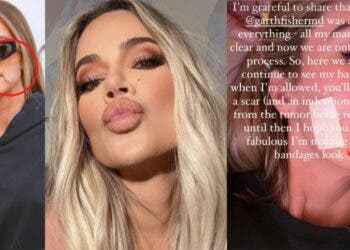El tumor que le extirparon de la cara a Khloé Kardashian.