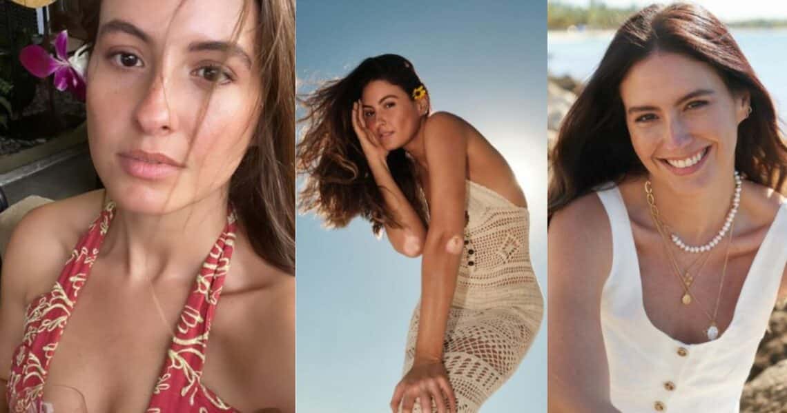 Taliana Vargas, quien padece del vitíligo, ha explicado cómo afecta su enfermedad a su vida